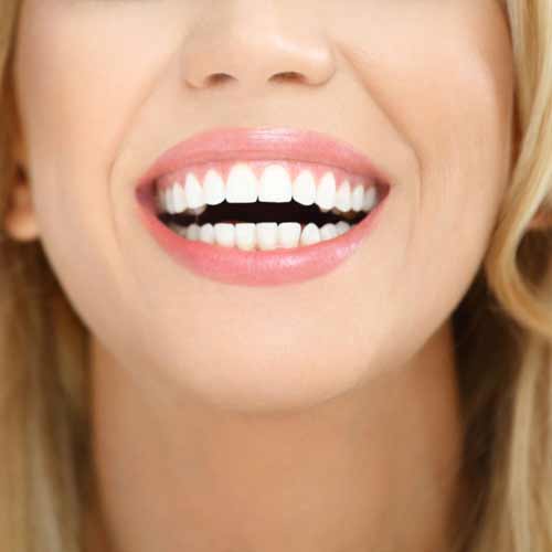 Laminates & Veneers Dental Pulse